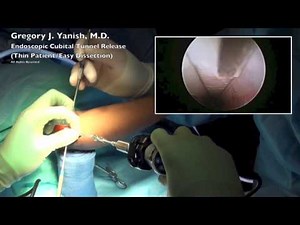 Endoscopic Cubital Tunnel Release (Thin Patient/Easy Dissection) • Video • MEDtube.net