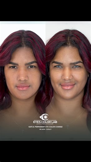 Eyes Color Lab on Instagram: "👁✨ Una transformación que comienza en tu mirada. ✨👁 La keratopigmentación es un procedimiento seguro, permanente y natural que te permite cambiar el color de tus ojos con precisión y armonía. En EyeColor Lab, cada tono se diseña de forma personalizada para resaltar tus rasgos y reflejar tu esencia de manera auténtica. Con el paso del tiempo, el color se integra suavemente, logrando un resultado luminoso, estable y completamente natural. Este proceso no solo transf