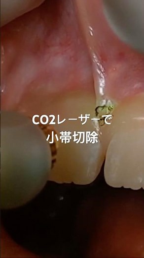 📍前歯のすき間が閉じない原因…実は“上唇小帯”かも？CO2レーザーで切除
