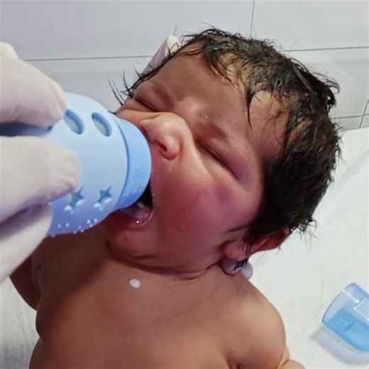13K views · 435 reactions | This video shows a microcephalic baby...