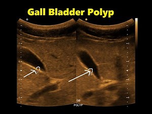 Tiny Gall Bladder Polyp || Ultrasound || Case 02