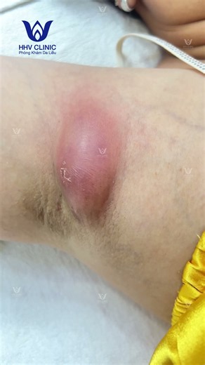 Mụn áp xe sung viêm to ở Nách