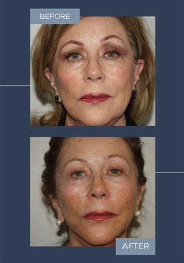 A deep plane transformation isn’t about changing who you are, it’s about restoring balance, structure, and confidence. When the deeper layers are thoughtfully repositioned, the result is natural, harmonious, and long-lasting. Subtle in execution. Powerful in impact. Learn more about the deep plane approach that delivers these results → doctorackerman.com 📞 (949) 759-3284