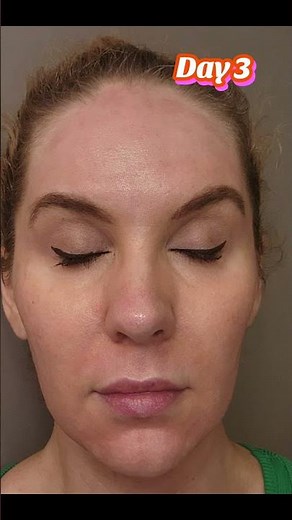 What is the downtime of a Cool Peel