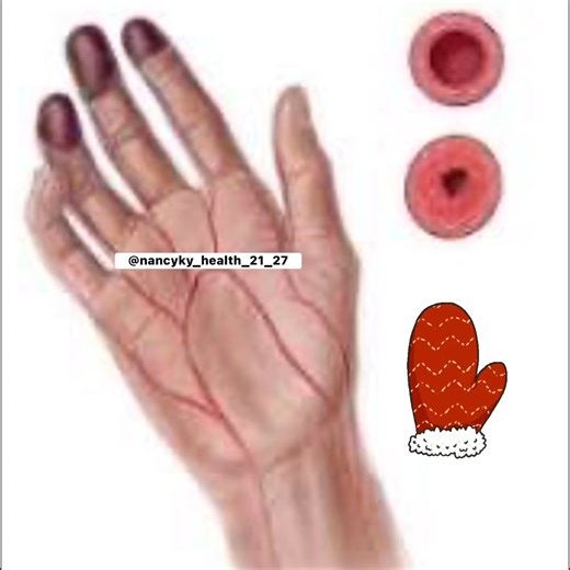 4.4K views · 11 reactions |  Cold hands can the early warning...