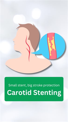 IRFacilities on Instagram: "Blocked carotid artery increases stroke risk. Carotid Stenting restores blood flow to the brain — without open surgery. ✨ Benefits: • reduces stroke risk • minimally invasive procedure • no surgery • shorter hospital stay • faster recovery 🧠 Treated by Dr. Sandeep Sharma 📍 IRFACILITIES – Cure Without Cutting 📞 86999-77915 #carotidstenting #strokeprevention #brainhealth #vascularcare #nonsurgicaltreatment #interventionalradiology #irfacilities #healthfirst #minimall
