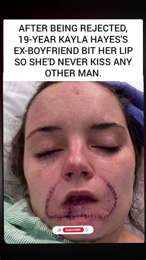 19-Year-Old Kayla Hayes’ Lip Bitten Off By Ex-Boyfriend After Rejection 😱