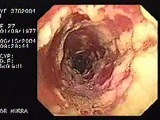 Oropharynge-Esophagic Candidiasis HIV-positive female patient (1 of 5) • Video • MEDtube.net