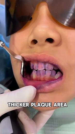 How do Disclosing tablets work #dentist #smile #beauty