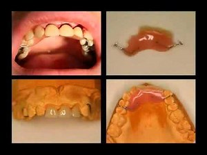 Temporary Dentures