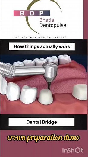 How is Dental Bridge made? #crown #newteeth #teeth