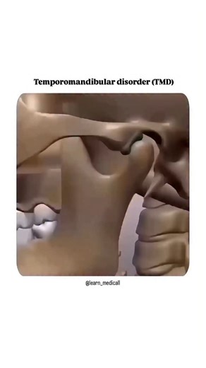 medicos_world on Instagram: "Temporomandibular disorder (TMD) affects the joints that connect the jaw to the skull, causing pain and difficulty moving the jaw. This disorder can be caused by various factors such as stress, bruxism (teeth clenching or grinding), injuries or muscle imbalances. Symptoms include pain in the jaw, head or neck, clicking when opening or closing the mouth, and difficulty chewing. Although the exact cause cannot always be identified, it can be managed with medical treatm