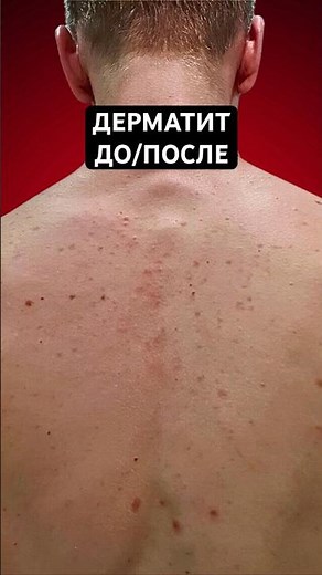 REDNESS ON YOUR BACK? Seboecytic dermatitis and atopic dermatitis can be treated. #redness