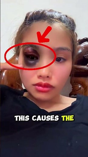 What Happens When You Get Punched in the Eye?😵👊