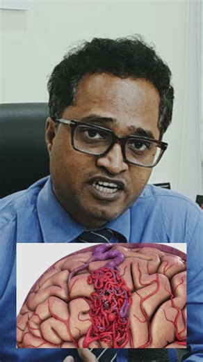 Arteriovenous malformation brain symptoms and treatment explained Dr Jagdish Shinde Oncologist Pune