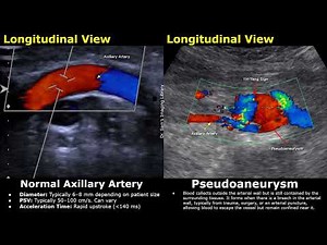 Axillary Artery B-Mode, Color & Spectral Doppler Ultrasound Normal Vs Abnormal Image Appearances USG