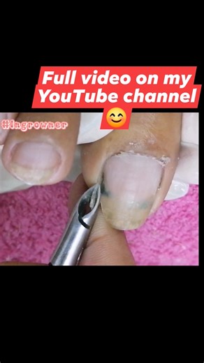 Dirty Toenail #satisfying #reels #fyp #nails #cleaning #metachallenge #Ingrowner | Ingrowner