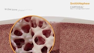 One Step Cartilage Repair: The CARTIHEAL Agili-C Cartilage Repair Implant Early Science to Positive Patient Impact