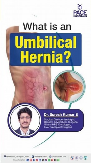 What is an Umbilical Hernia? | The Basics of Umbilical Hernias #umbilicalhernia