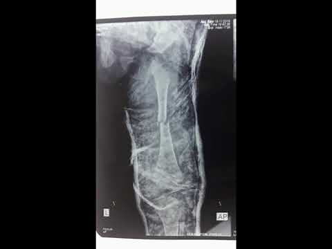 Hip spica application by Dr Sameer Desai ,Pediatric Orthopedic Surgeon