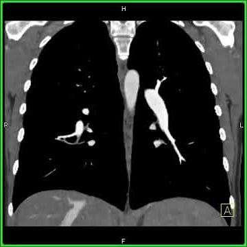Lung Anatomy: Pulmonary Embolism (Coronal View)