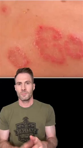 Dr. Joe, M.D. on Instagram: "What looks like ringworm but isn’t contagious? It’s called nummular dermatitis—those coin-shaped patches of itchy, inflamed skin that love to show up in the winter. Here’s what causes it and how to treat it. #Ringworm #dermatitis #eczema #rash"