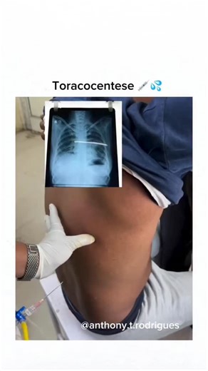 El Estudiante de Enfermería | La toracocentesis es un procedimiento médico para extraer líquido acumulado en el espacio entre los pulmones y la pared torácica (el... | Instagram