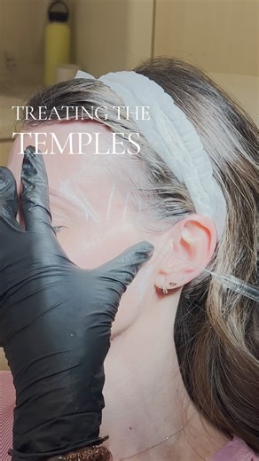 Nicola Lowrey PA-C on Instagram: "The temple is one of the most misunderstood regions of the face. There are countless publications, multiple techniques, and very little consensus, which leaves many injectors unsure of what’s safest, what actually works, and where problems begin. Here’s how I approach it. I enter just superior to the lateral zygoma and advance the cannula into the interfascial plane (Layer 4). This is a smooth gliding, predominantly avascular plane, with the sentinel vein being 