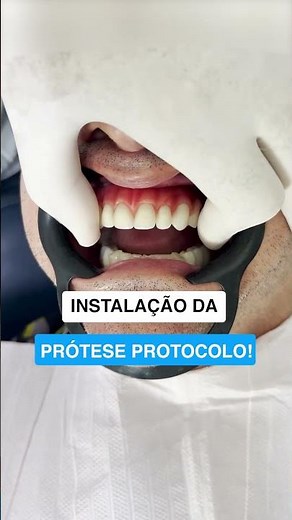Instalação de Prótese Protocolo