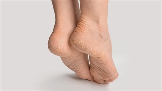 Dry Skin On Your Feet: Try These Home Remedies To Soothe And Revitalise Your Soles