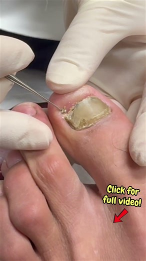 Part 2: Ultra Satisfying Toe Jam Clean Out! #satisfyingshorts #shortsvideos