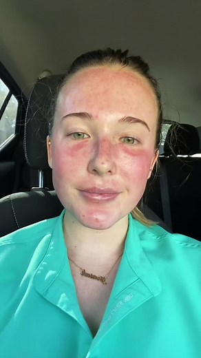 Lumecca IPL Treatment Experience | Before & After Results