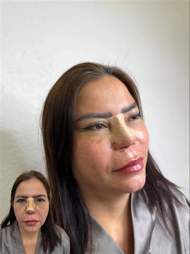 The eyelids combo, fox eye lift and Rhinoplasty is a combo that makes your face look 10 years younger, Book your appointment now for November to get the biggest discount of the year only November 2025 ☎️whatsap: 971544399688 Consult with your doctor and book an appointment today to get special offers in October and November. #foxyeye #rhinoplasty #tabbypayent ✅we accep #tabby payment link! | CLINE Clinic