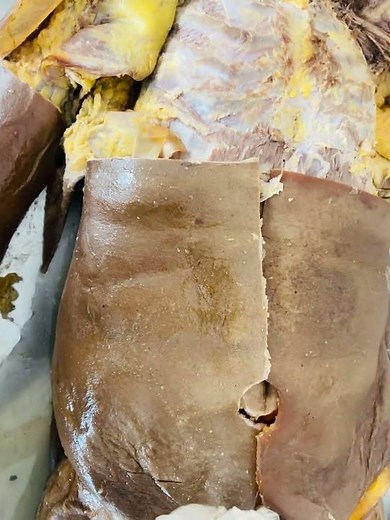 Anterior Abdominal Wall | Cadaveric Dissection & Anatomy Explained #anatomyshorts #medicalstudent