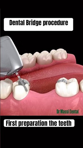 Dental Bridge Procedure