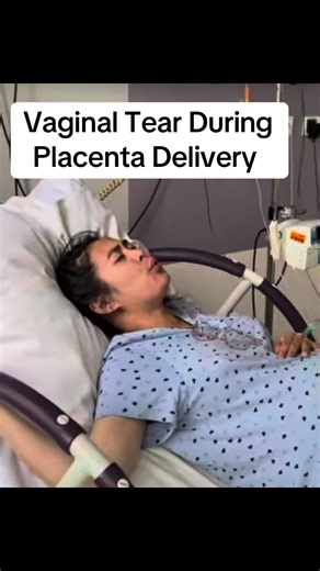 Understanding Vaginal Tears During Placenta Delivery