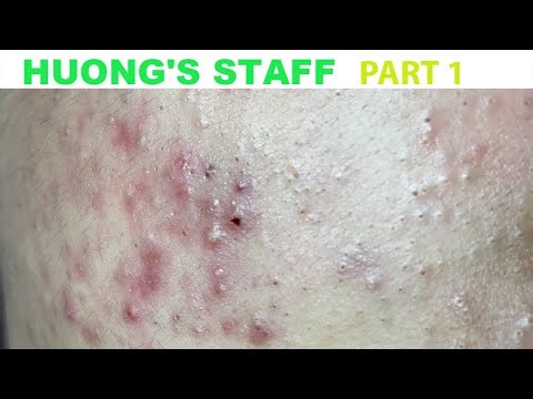 Acne Treatment Huong Da Nang#748#Huong's staff_ Part1 Blackheads and inflammation TET Holiday