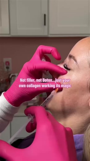 Sculptra: The Ultimate Skin Investment for Collagen Boost