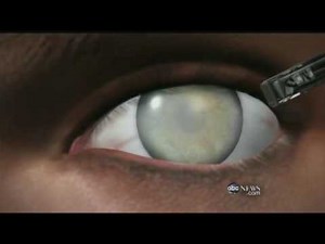 Medical Breakthrough: Restoring Sight to the Blind