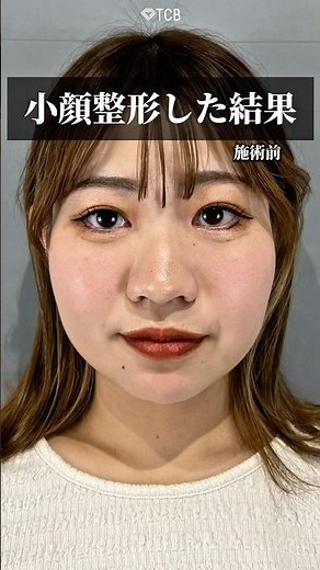 [Liposuction] Results of facial contouring #shorts
