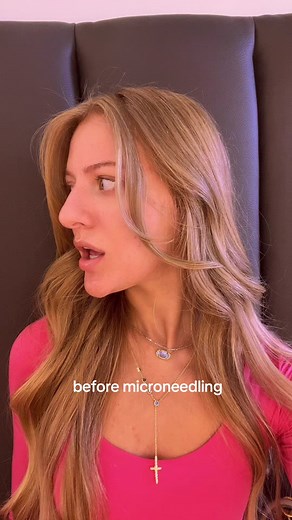 Transformed Skin Results with Microneedling at The Skin Center