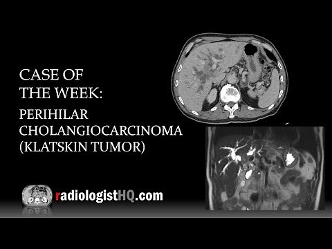 Case of the Week: Perihilar Cholangiocarcinoma/Klatskin Tumor (CT & MRI)