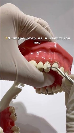 ✨ Mastering the T-shape crown preparation| Dr.Dentique-hub