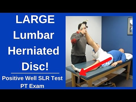 Positive Well Straight Leg Raise Test (Large Herniated Disc)