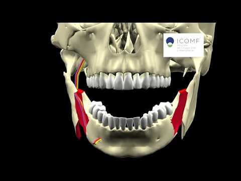 AVANCE MANDIBULAR OSTEOTOMIA SAGITAL