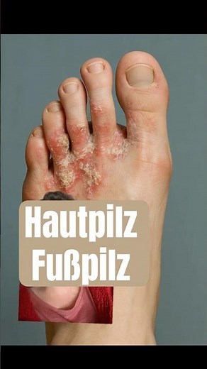 Skin fungus, athlete's foot