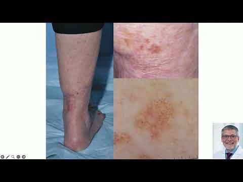 (Part 1 of 2) Dermoscopy Primer - Ashfaq Marghoob, MD