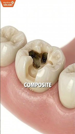 Sâu Răng, Mẻ Răng Nên Trám Composite Hay Bọc Sứ? Xem Ngay Để Tránh Chọn Sai