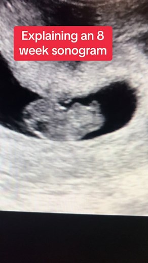 8 Week Ultrasound: Baby's First Appearance