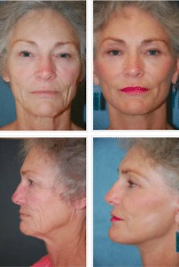 Facelift Wilmington DE - Top Facelift Surgeon Chadds Ford PA